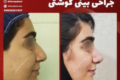 جراحی-بینی-21