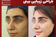 جراحی-بینی-22
