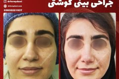 جراحی-بینی-23