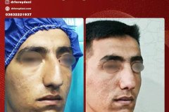 جراحی-بینی-28