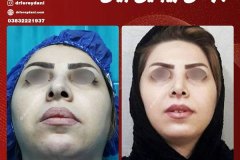 جراحی-بینی-3