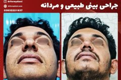 جراحی-بینی-31