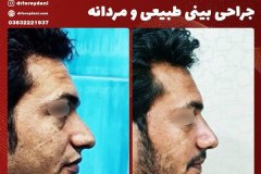 جراحی-بینی-32