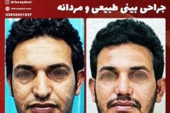 جراحی-بینی-33