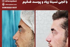 جراحی-بینی-34
