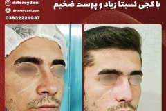 جراحی-بینی-35