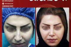 جراحی-بینی-4