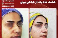 جراحی-بینی-41