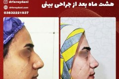 جراحی-بینی-42