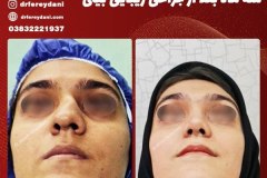 جراحی-بینی-44