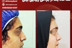 جراحی-بینی-45