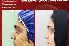 جراحی-بینی-46