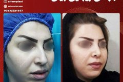 جراحی-بینی-5