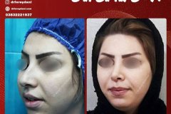 جراحی-بینی-6