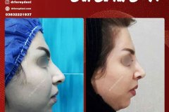 جراحی-بینی-7