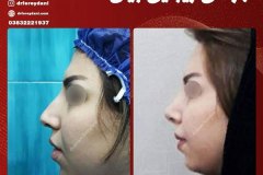 جراحی-بینی-8