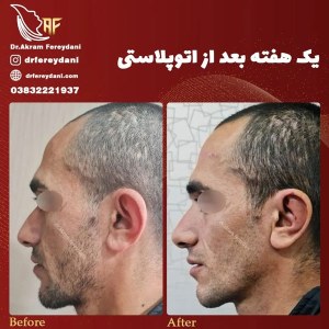 جراحی-گوش-4