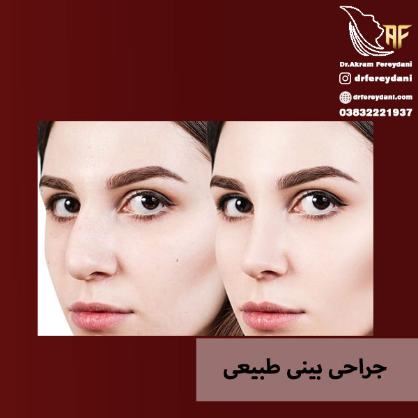 جراحی بینی طبیعی - دکتر فریدنی