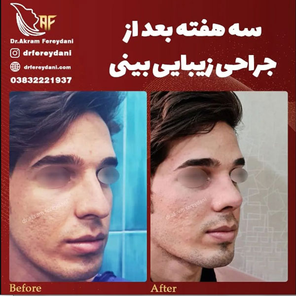 عمل بینی مردانه - دکتر فریدنی 