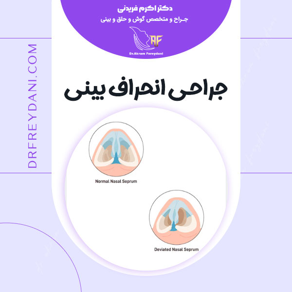 عمل انحراف بینی