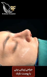 نمونه عمل بینی - دکتر اکرم فریدنی