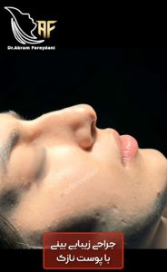 جراحی زیبایی بینی _ فریدنی