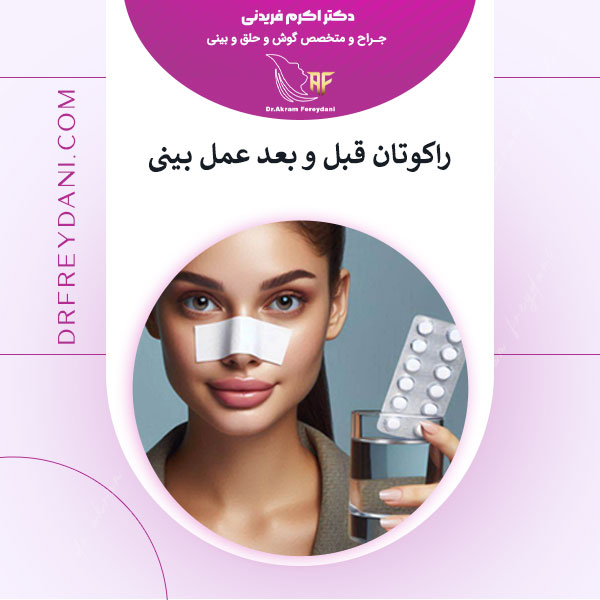 راکوتان قبل و بعد عمل بینی - دکتر اکرم فریدنی