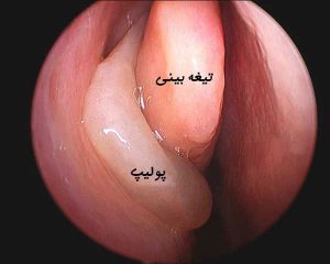 عکس پولیپ بینی _ دکتر اکرم فریدنی