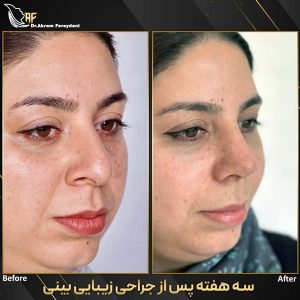نمونه قبل و بعد جراحی بینی _ دکتر اکرم فریدنی