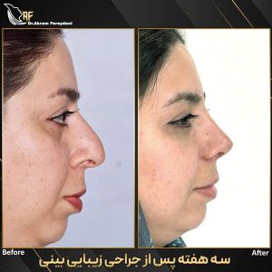 نمونه کار جراحی بینی _ دکتر اکرم فریدنی