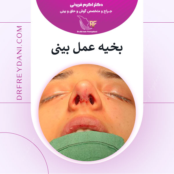 بخیه عمل بینی _ دکتر اکرم فریدنی