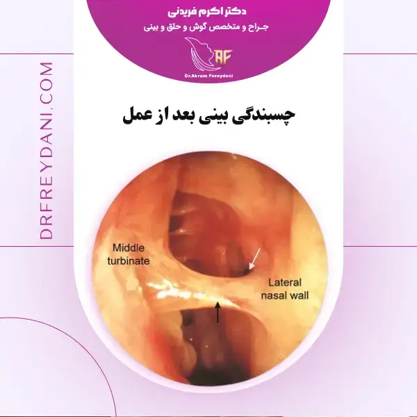 چسبندگی بینی بعد از عمل _ دکتر اکرم فریدنی
