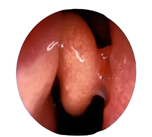 عکس چسبندگی بینی بعد از عمل _ دکتر اکرم فریدنی