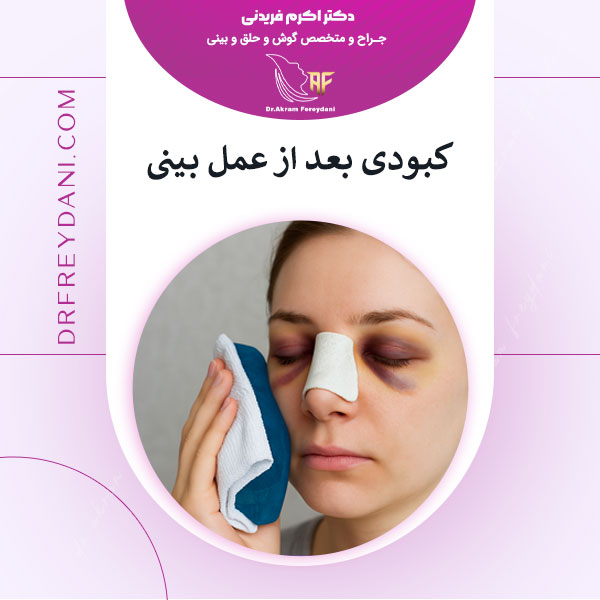 کبودی بعد از عمل بینی