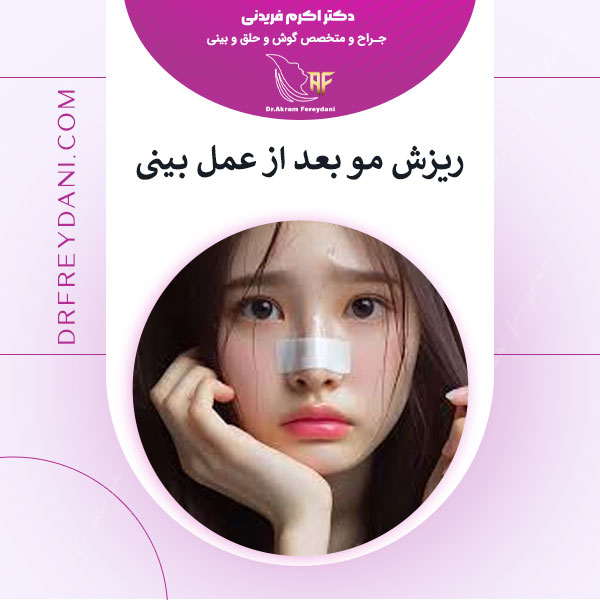 ریزش مو بعد از جراحی بینی