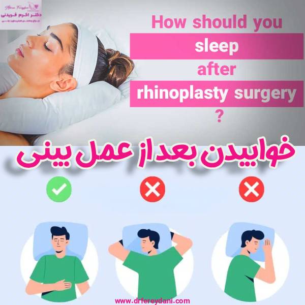 خوابیدن بعد از عمل بینی - دکتر اکرم فریدنی