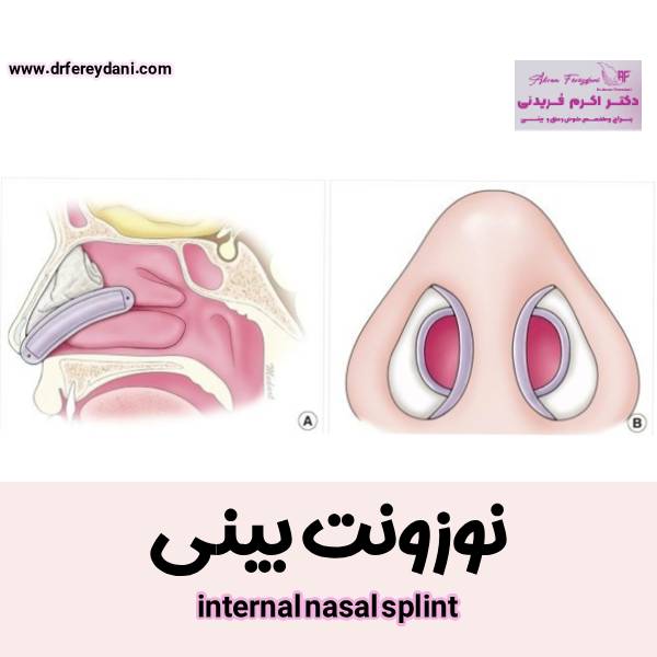 نوزونت بینی - دکتر اکرم فریدنی