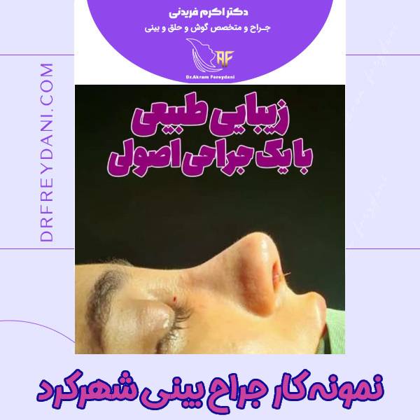 عکس بعد جراحی بینی در شهرکرد - دکتر اکرم فریدنی