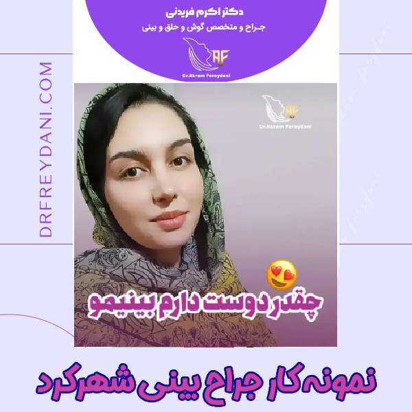 عکس نمونه کار بعد جراحی بینی شهرکرد - دکتر اکرم فریدنی