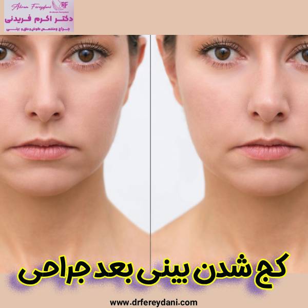 کج شدن بینی بعد عمل - دکتر اکرم فریدنی