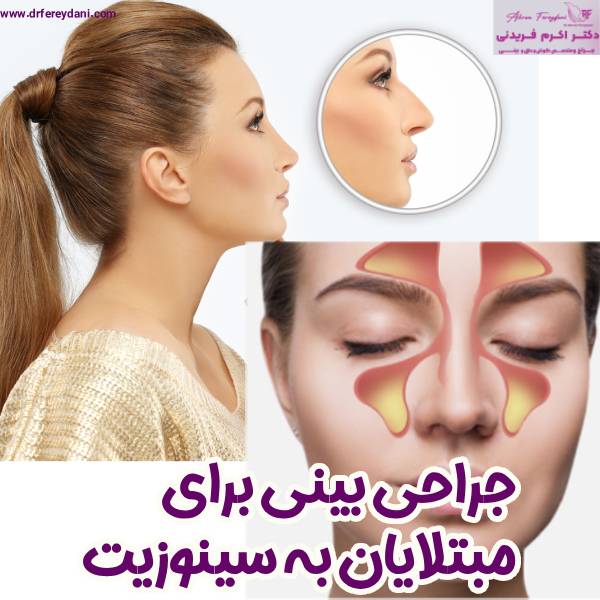 جراحی بینی برای مبتلایان به سینوزیت - دکتر اکرم فریدنی