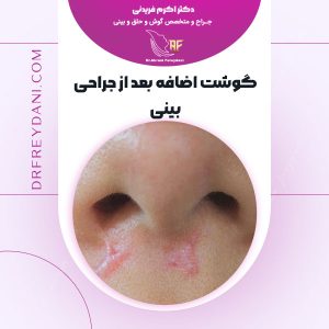 گوشت اضافه بعد از جراحی بینی